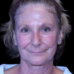 Facelift Before & After Patient #9865