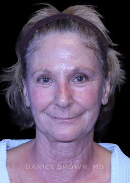 Facelift Before & After Patient #9865