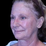 Facelift Before & After Patient #9865