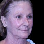 Facelift Before & After Patient #9865