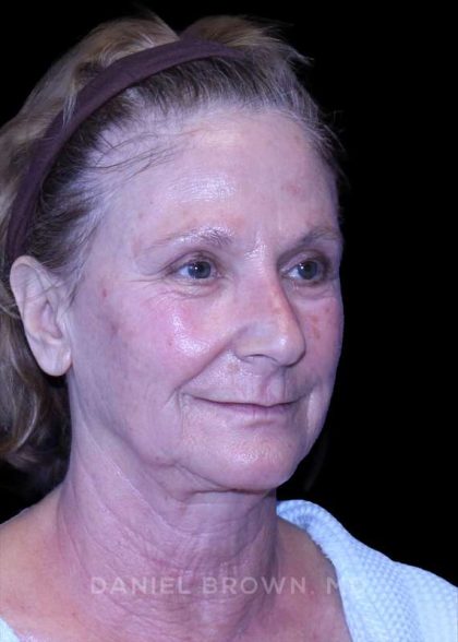 Facelift Before & After Patient #9865