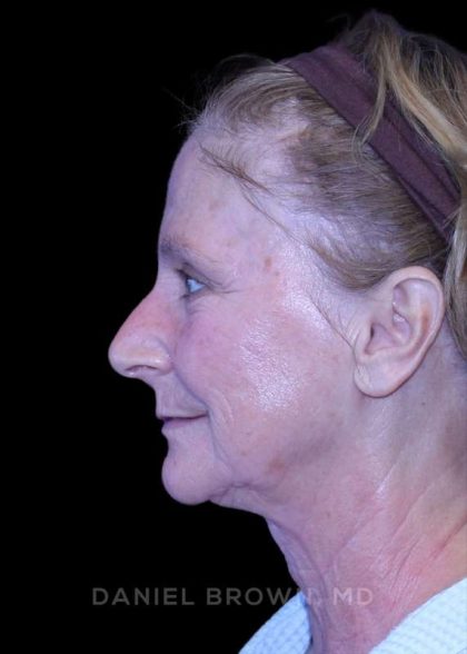 Facelift Before & After Patient #9865