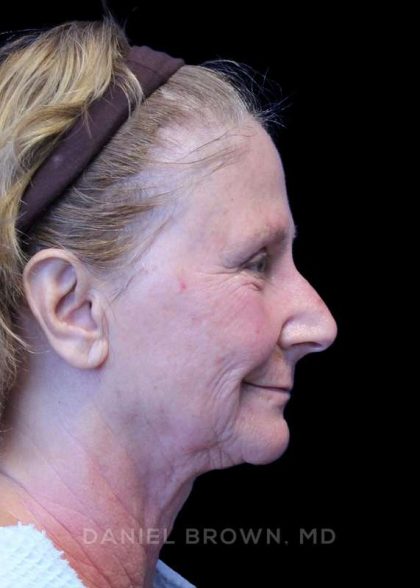 Facelift Before & After Patient #9865