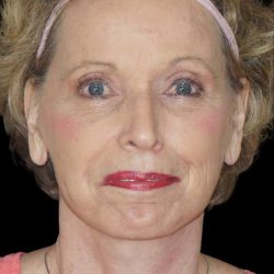 Facelift Before & After Patient #9876