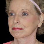 Facelift Before & After Patient #9876