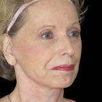 Facelift Before & After Patient #9876