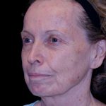 Facelift Before & After Patient #9876