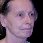 Facelift Before & After Patient #9876