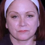 Facelift Before & After Patient #9887