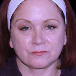 Facelift Before & After Patient #9887