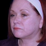 Facelift Before & After Patient #9887