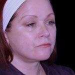 Facelift Before & After Patient #9887
