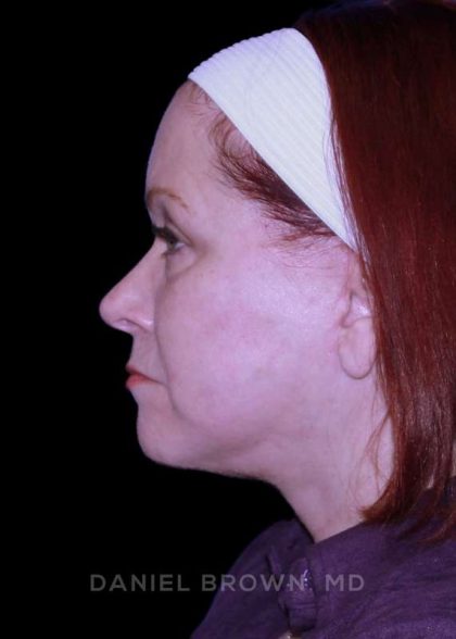 Facelift Before & After Patient #9887