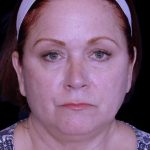 Facelift Before & After Patient #9887