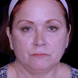Facelift Before & After Patient #9887