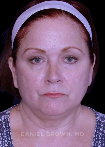 Facelift Before & After Patient #9887