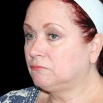 Facelift Before & After Patient #9887