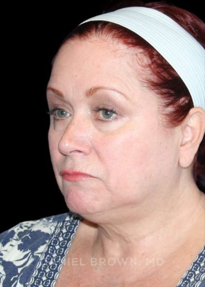 Facelift Before & After Patient #9887