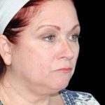 Facelift Before & After Patient #9887
