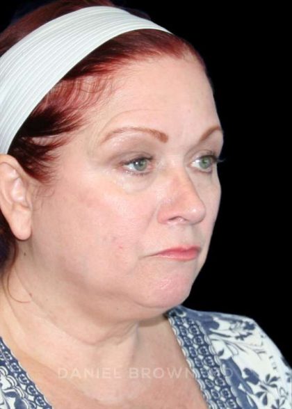 Facelift Before & After Patient #9887