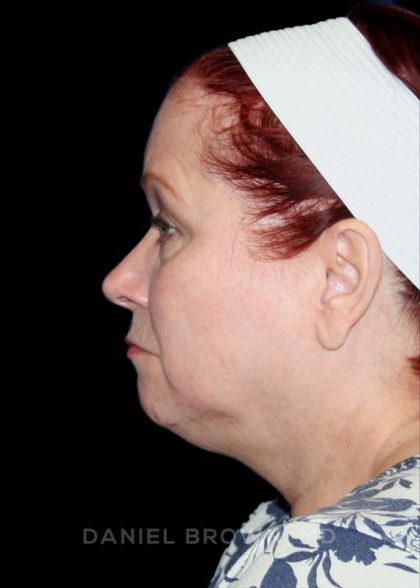 Facelift Before & After Patient #9887