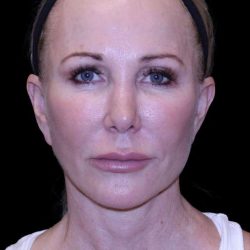 Facelift Before & After Patient #9898