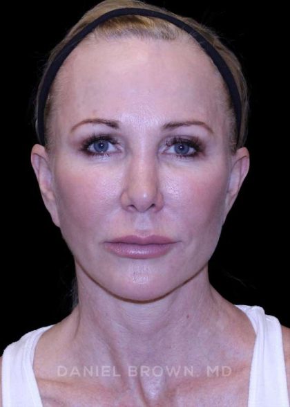 Facelift Before & After Patient #9898
