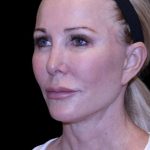 Facelift Before & After Patient #9898
