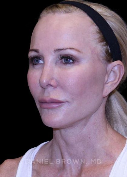 Facelift Before & After Patient #9898
