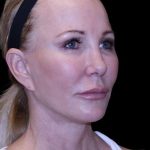 Facelift Before & After Patient #9898
