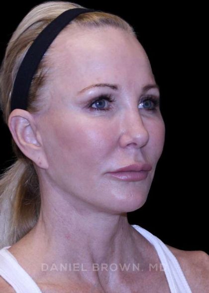 Facelift Before & After Patient #9898