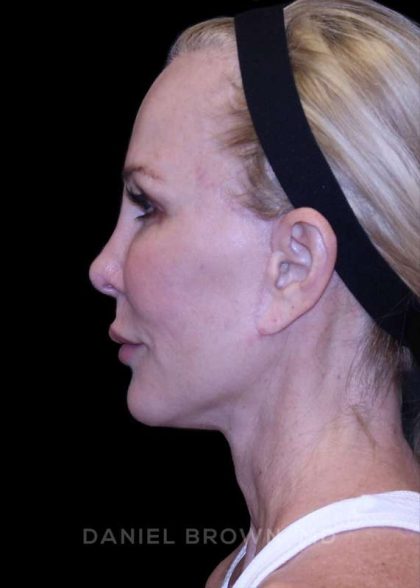 Facelift Before & After Patient #9898