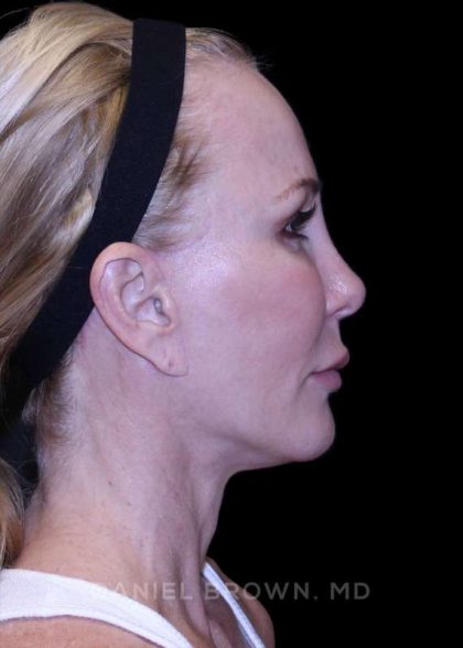 Facelift Before & After Patient #9898