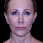 Facelift Before & After Patient #9898