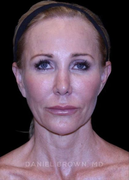 Facelift Before & After Patient #9898