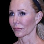 Facelift Before & After Patient #9898