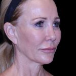 Facelift Before & After Patient #9898