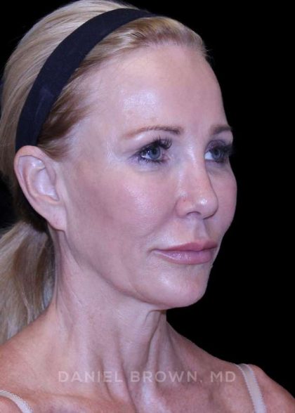 Facelift Before & After Patient #9898
