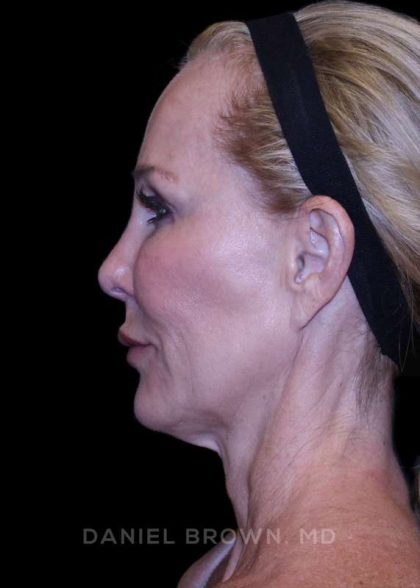 Facelift Before & After Patient #9898