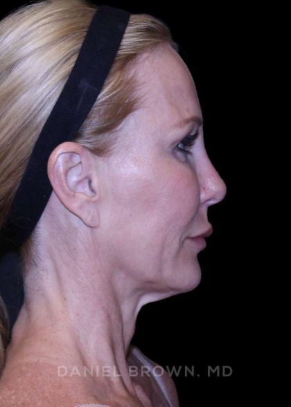 Facelift Before & After Patient #9898