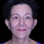 Facelift Before & After Patient #9909