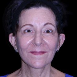 Facelift Before & After Patient #9909