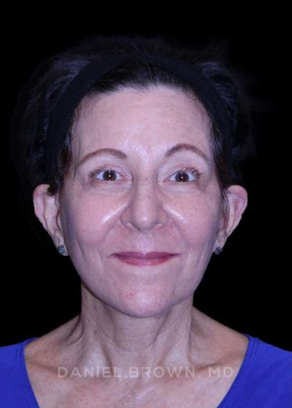 Facelift Before & After Patient #9909