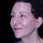 Facelift Before & After Patient #9909