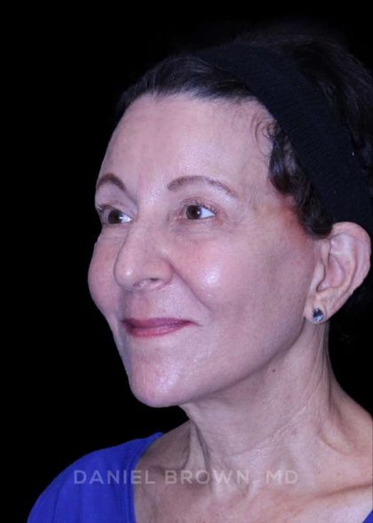 Facelift Before & After Patient #9909