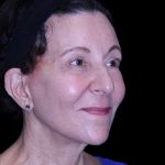 Facelift Before & After Patient #9909