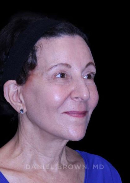 Facelift Before & After Patient #9909