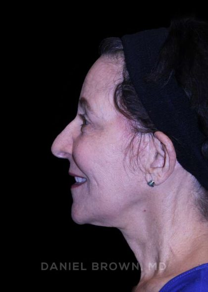 Facelift Before & After Patient #9909