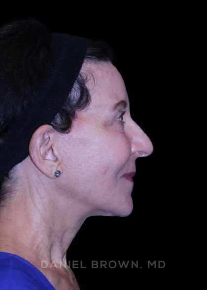Facelift Before & After Patient #9909