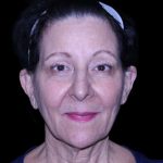 Facelift Before & After Patient #9909